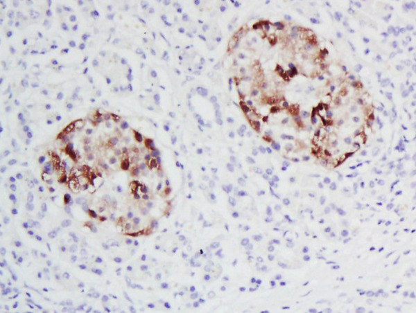 Formalin-fixed and paraffin embedded human pancreas carcinoma labeled with Rabbit Anti-Snail Polyclonal Antibody, Unconjugated (bs-1371R) at 1:200 followed by conjugation to the secondary antibody and DAB staining\n