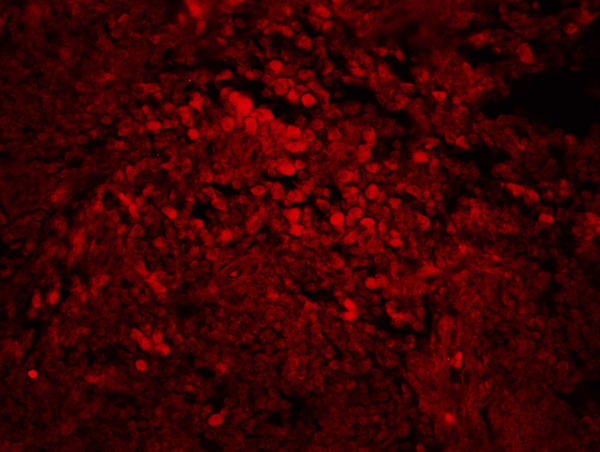 Formalin-fixed and paraffin-embedded human laryngocarcinoma labeled with Rabbit Anti-Snail Polyclonal Antibody, Unconjugated(bs-1371R) 1:200, overnight at 4°C, The secondary antibody was Goat Anti-Rabbit IgG, Cy3 conjugated(bs-0295G-Cy3)used at 1:200 dilution for 40 minutes at 37°C.\n