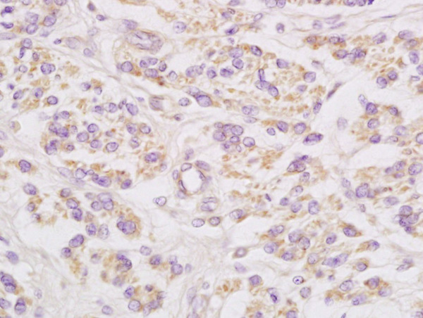 Formalin-fixed and paraffin embedded human cervical carcinoma labeled with Anti-Connexin-32 Polyclonal Antibody, Unconjugated (bs-1376R) at 1:200 followed by conjugation to the secondary antibody and DAB staining\n