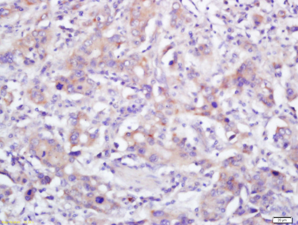 Formalin-fixed and paraffin embedded human gastric carcinoma labeled with Anti-pan Cadherin Polyclonal Antibody, Unconjugated (bs-1519R) at 1:200 followed by conjugation to the secondary antibody and DAB staining\n
