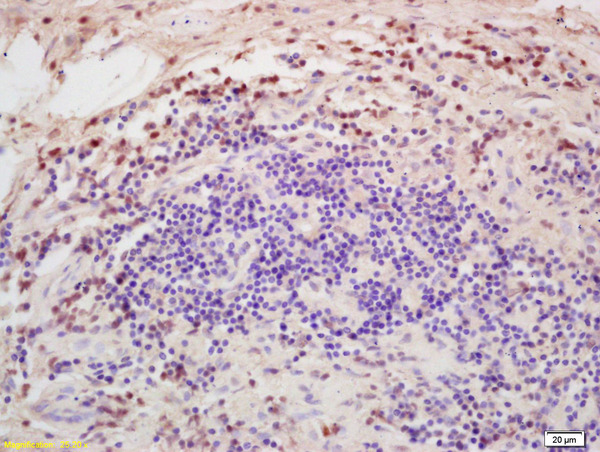 Formalin-fixed and paraffin embedded human colon carcinoma labeled with Rabbit Anti DGAT1/Diglyceride acyltransferase Polyclonal Antibody, Unconjugated (bs-2332R) at 1:200 followed by conjugation to the secondary antibody and DAB staining