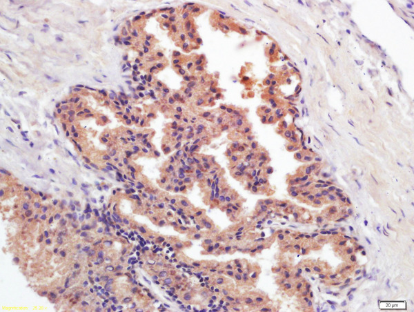 Formalin-fixed and paraffin embedded human prostate carcinoma labeled with Mouse Anti-PSA (PA5) Monoclonal Antibody, Unconjugated (bsm-1626M) at 1:200 followed by conjugation to the secondary antibody and DAB staining\n Formalin-fixed and paraffin embedded human prostate carcinoma labeled with Mouse Anti-PSA (PA5) Monoclonal Antibody, Unconjugated (bsm-1626M) at 1:200 followed by conjugation to the secondary antibody and DAB staining\n