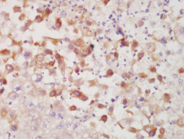 Formalin-fixed and paraffin embedded human lung carcinoma labeled with Rabbit Anti-CK7 Polyclonal Antibody, Unconjugated (bs-1744R) at 1:200 followed by conjugation to the secondary antibody and DAB staining\n