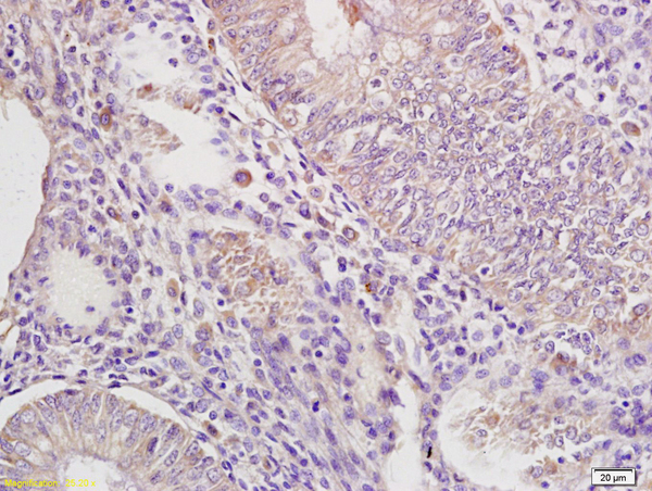 Formalin-fixed and paraffin embedded human  endometrium  carcinoma labeled with  Rabbit Anti IRAK4 Polyclonal Antibody, Unconjugated (bs-2440R) at 1:200 followed by conjugation to the secondary antibody and DAB staining