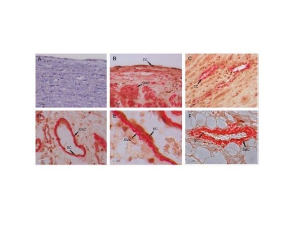 Image kindly submitted by Dr. Wellbrock of the University Medical Center Hamburg-Eppendorf. Formalin-fixed and paraffin embedded human aortic tissue sections labeled with Rabbit Anti-Gremlin Polyclonal Antibody, Unconjugated (bs-1475R) at 1:200 followed by conjugation to the secondary antibody and DAB staining