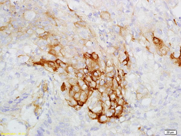 Formalin-fixed and paraffin embedded human esophageal carcinoma labeled with Rabbit Anti-CK7 Polyclonal Antibody, Unconjugated (bs-1610R) at 1:200 followed by conjugation to the secondary antibody and DAB staining