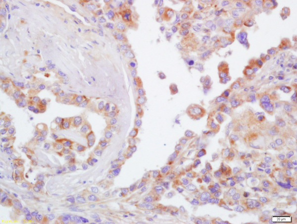 Formalin-fixed and paraffin embedded human lung carcinoma labeled with Rabbit Anti-CD44 Polyclonal Antibody (bs-0521R) at 1:200 followed by conjugation to the secondary antibody and DAB staining