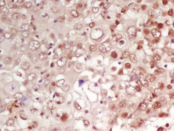 Formalin-fixed and paraffin embedded human laryngeal carcinoma labeled with Rabbit Anti-CDK1 Polyclonal Antibody, Unconjugated (bs-0542R) at 1:200 followed by conjugation to the secondary antibody and DAB staining