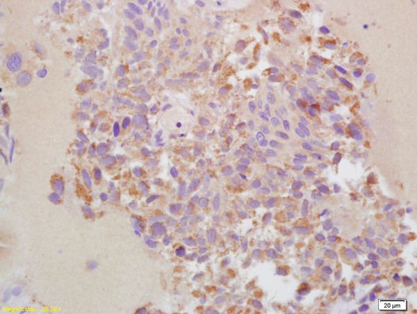 Formalin-fixed and paraffin embedded human bladder cancer labeled with Rabbit Anti-MMP-13 Polyclonal Antibody, Unconjugated (bs-0575R) at 1:200 followed by conjugation to the secondary antibody and DAB staining\\n