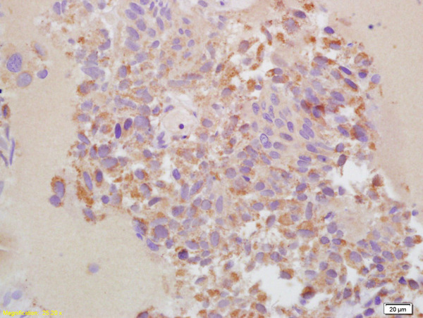 Formalin-fixed and paraffin embedded human bladder cancer labeled with Rabbit Anti-MMP-13 Polyclonal Antibody, Unconjugated (bs-0575R) at 1:200 followed by conjugation to the secondary antibody and DAB staining\n