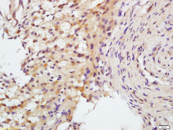 Formalin-fixed and paraffin embedded human placenta labeled with Rabbit Anti-FSH receptor Polyclonal Antibody, Unconjugated (bs-0895R) at 1:200 followed by conjugation to the secondary antibody and DAB staining