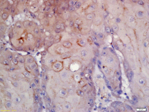 Formalin-fixed and paraffin embedded human laryngeal carcinoma labeled with Rabbit Anti-CD276\/B7H3 Polyclonal Antibody, Unconjugated (bs-11019R) at 1:200 followed by conjugation to the secondary antibody and DAB staining