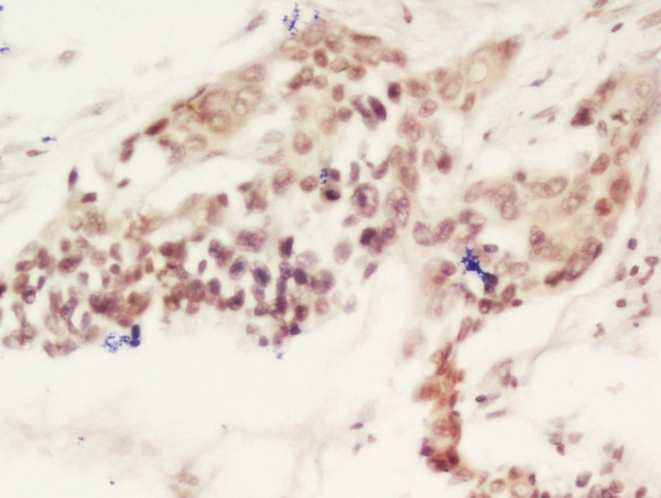 Formalin-fixed and paraffin embedded labeled with Rabbit Anti-CEBP gamma Polyclonal Antibody, Unconjugated (bs-11188R) at 1:200 followed by conjugation to the secondary antibody and DAB staining