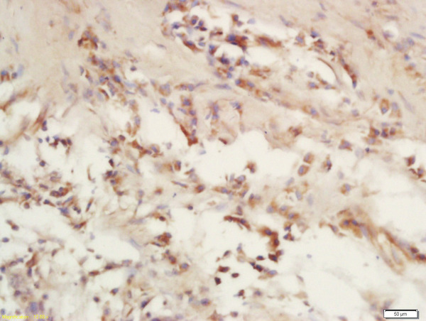 Formalin-fixed and paraffin embedded human laryngeal carcinoma labeled with Rabbit Anti-COX6c/Cytochrome C Oxidase subunit VIc Polyclonal Antibody, Unconjugated (bs-12925R) at 1:200 followed by conjugation to the secondary antibody and DAB staining