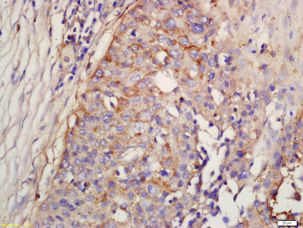 Formalin-fixed and paraffin embedded human lung carcinoma labeled with Rabbit Anti-Factor D/Adipsin Polyclonal Antibody, Unconjugated (bs-13130R) at 1:200 followed by conjugation to the secondary antibody and DAB staining