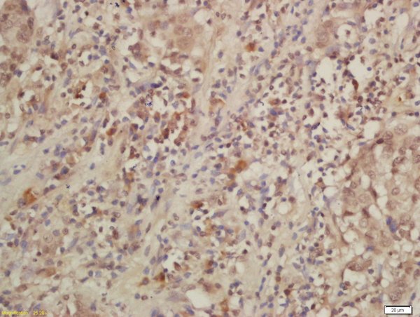 Formalin-fixed and paraffin embedded human larynx labeled with Rabbit Anti-IL-28R Polyclonal Antibody, Unconjugated (bs-11137R) at 1:200 followed by conjugation to the secondary antibody and DAB staining