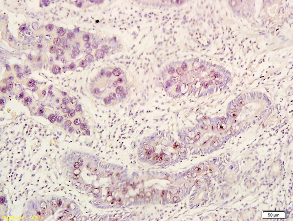 Formalin-fixed and paraffin embedded human gastric carcinoma labeled with Rabbit Anti BMI1/PCGF4 Polyclonal Antibody, Unconjugated (bs-2999R) at 1:200 followed by conjugation to the secondary antibody and DAB staining