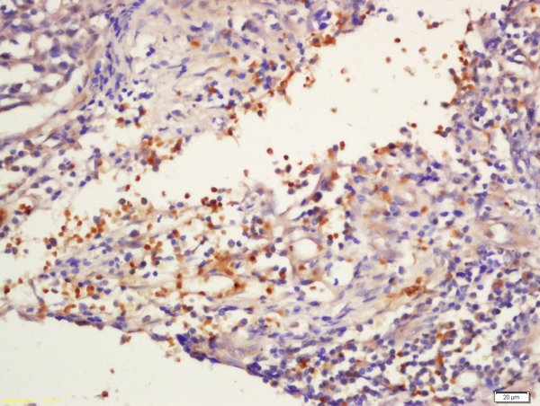Formalin-fixed and paraffin embedded human larynx labeled with Rabbit Anti-GNLY/NKG5 Polyclonal Antibody, Unconjugated (bs-2577R) at 1:200 followed by conjugation to the secondary antibody and DAB staining