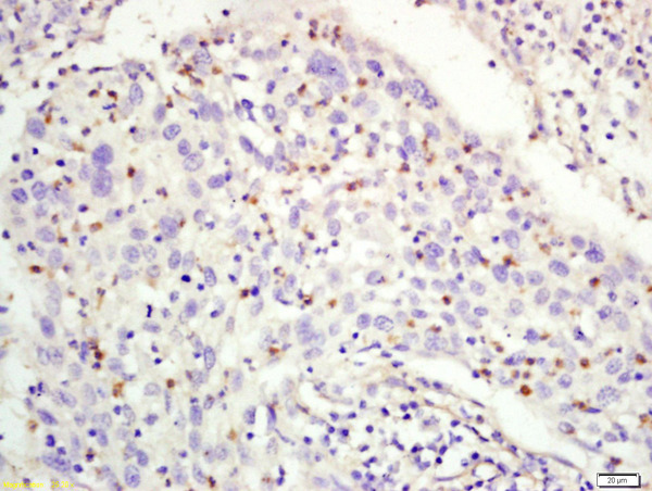 Formalin-fixed and paraffin embedded human larngeal cancer labeled with Rabbit Anti-RFC1 Polyclonal Antibody, Unconjugated (bs-11304R) at 1:200 followed by conjugation to the secondary antibody and DAB staining\n