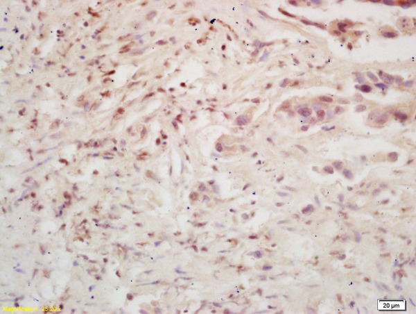 Formalin-fixed and paraffin embedded human colon carcinoma labeled with Rabbit Anti BMI1/PCGF4 Polyclonal Antibody, Unconjugated (bs-2999R) at 1:200 followed by conjugation to the secondary antibody and DAB staining