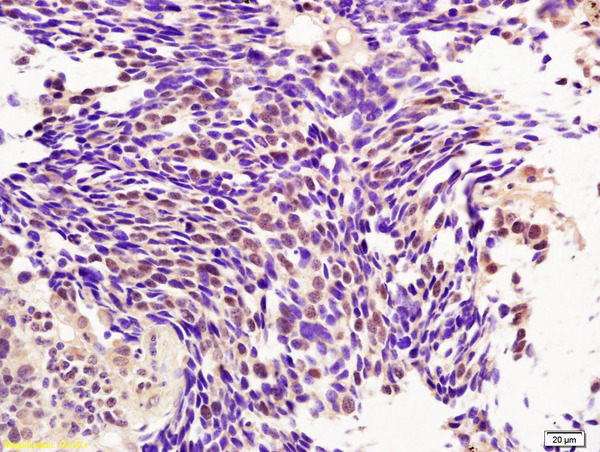 Formalin-fixed and paraffin embedded human lung carcinoma labeled with Rabbit Anti BMI1/PCGF4 Polyclonal Antibody, Unconjugated (bs-2999R) at 1:200 followed by conjugation to the secondary antibody and DAB staining