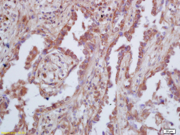 Formalin-fixed and paraffin embedded human lung carcinoma labeled with Rabbit Anti-GAS 6 Polyclonal Antibody, Unconjugated (bs-7549R) at 1:200 followed by conjugation to the secondary antibody and DAB staining