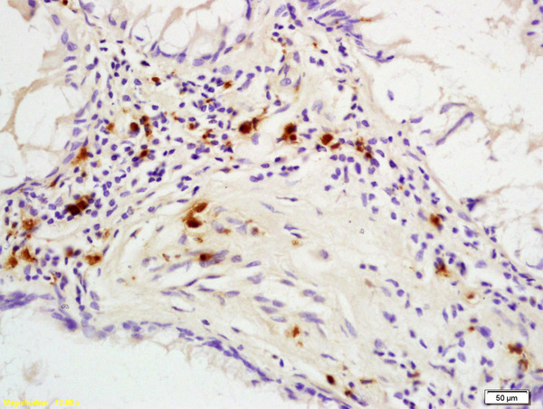 Formalin-fixed and paraffin embedded human colon carcinoma labeled with Rabbit Anti phospho-p53BP1(Ser25/29) Polyclonal Antibody, Unconjugated (bs-3020R) at 1:200 followed by conjugation to the secondary antibody and DAB staining