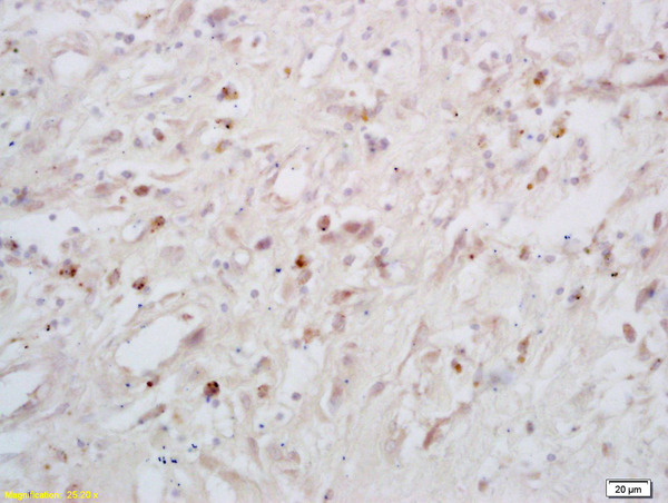 Formalin-fixed and paraffin embedded human lung carcinoma labeled with Rabbit Anti phospho-p53BP1(Ser25/29) Polyclonal Antibody, Unconjugated (bs-3020R) at 1:200 followed by conjugation to the secondary antibody and DAB staining