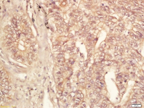 Formalin-fixed and paraffin embedded human lung carcinoma labeled with Rabbit Anti-eIF4ENIF1 Polyclonal Antibody, Unconjugated (bs-14561R) at 1:200 followed by conjugation to the secondary antibody and DAB staining