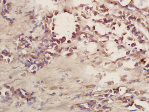 Formalin-fixed and paraffin embedded human lung carcinoma labeled with Rabbit Anti-CD101 Polyclonal Antibody, Unconjugated (bs-10727R) at 1:200 followed by conjugation to the secondary antibody and DAB staining