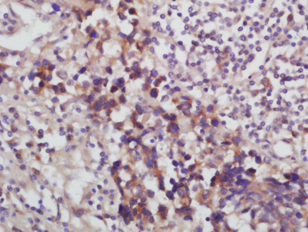 Formalin-fixed and paraffin embedded labeled with Anti-Desmoglein 2 Polyclonal Antibody, Unconjugated (bs-10152R) at 1:200 followed by conjugation to the secondary antibody and DAB staining