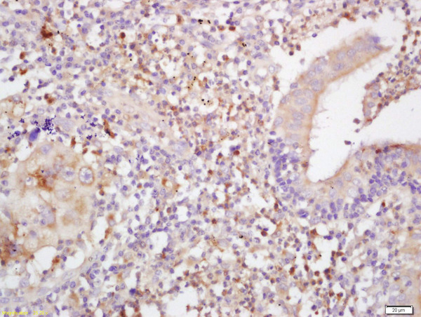 Formalin-fixed and paraffin embedded human lung carcinoma labeled with Anti-MHC Class I Polyclonal Antibody, Unconjugated (bs-10251R) at 1:200 followed by conjugation to the secondary antibody and DAB staining
