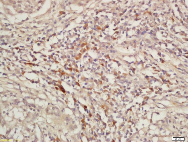 Formalin-fixed and paraffin embedded laryngeal cancer labeled with Rabbit Anti-KIF11 Polyclonal Antibody, Unconjugated (bs-8177R) at 1:200 followed by conjugation to the secondary antibody and DAB staining\n