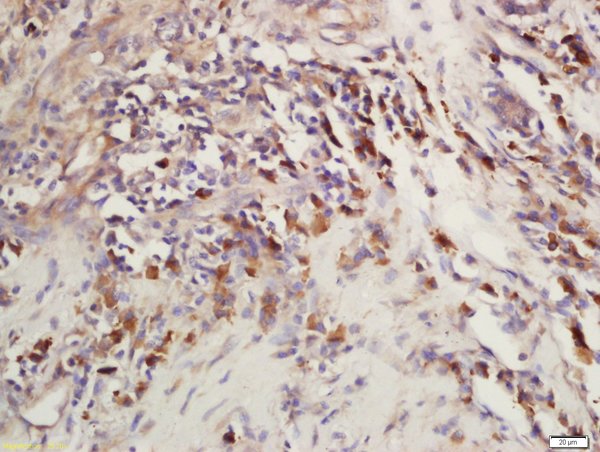 Formalin-fixed and paraffin embedded human laryngeal carcinoma labeled with Rabbit Anti-CEP120 Polyclonal Antibody, Unconjugated (bs-13850R) at 1:200 followed by conjugation to the secondary antibody and DAB staining