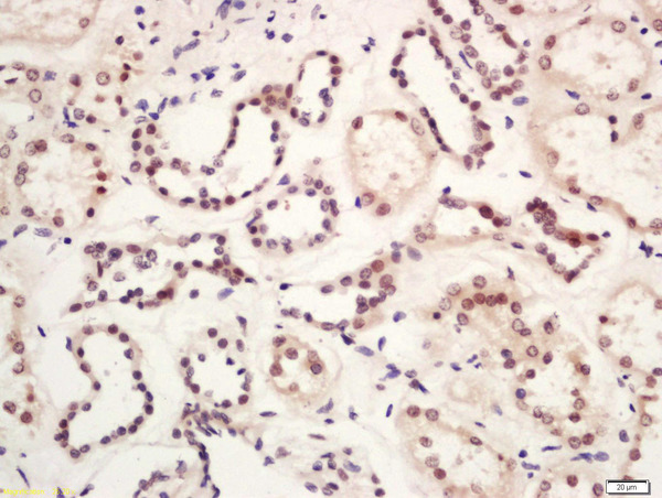 Formalin-fixed and paraffin embedded human kidney labeled with Rabbit Anti-GLIS3 Polyclonal Antibody, Unconjugated (bs-16249R) at 1:200 followed by conjugation to the secondary antibody and DAB staining