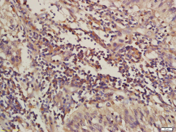 Formalin-fixed and paraffin embedded human laryngeal carcinoma labeled with Rabbit Anti-C4orf21 Polyclonal Antibody, Unconjugated (bs-15188R) at 1:200 followed by conjugation to the secondary antibody and DAB staining Formalin-fixed and paraffin embedded human laryngeal carcinoma labeled with Rabbit Anti-C4orf21 Polyclonal Antibody, Unconjugated (bs-15188R) at 1:200 followed by conjugation to the secondary antibody and DAB staining