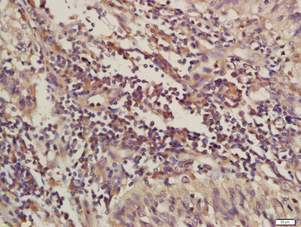 Formalin-fixed and paraffin embedded human laryngeal carcinoma labeled with Rabbit Anti-C4orf21 Polyclonal Antibody, Unconjugated (bs-15188R) at 1:200 followed by conjugation to the secondary antibody and DAB staining