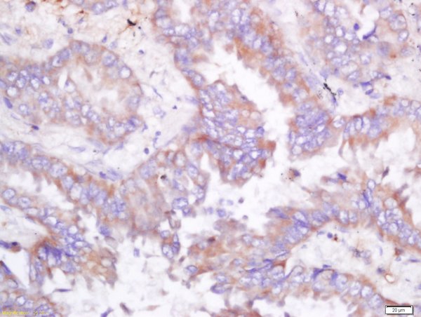 Formalin-fixed and paraffin embedded human lung carcinoma labeled with Rabbit Anti-ODC Polyclonal Antibody, Unconjugated (bs-1294R) at 1:200 followed by conjugation to the secondary antibody and DAB staining