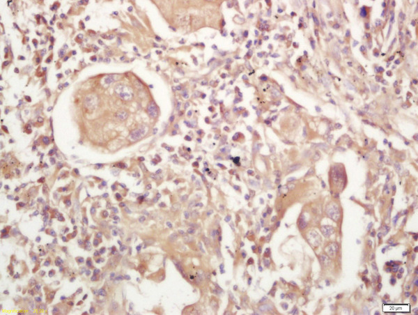 Formalin-fixed and paraffin embedded human lung carcinoma labeled with Rabbit Anti-MHC Class II Polyclonal Antibody, Unconjugated (bs-8481R) at 1:200 followed by conjugation to the secondary antibody and DAB staining\\n