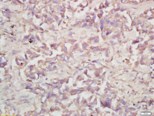 Formalin-fixed and paraffin embedded human lung carcinoma labeled with Rabbit Anti-V-ATPase A1 Polyclonal Antibody, Unconjugated (bs-7410R) at 1:200 followed by conjugation to the secondary antibody and DAB staining\n
