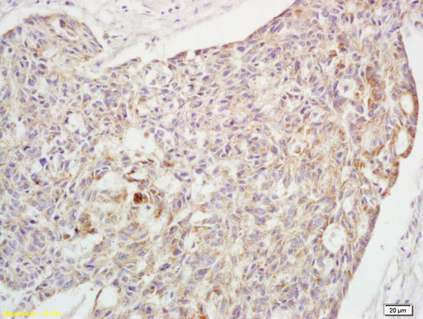 Formalin-fixed and paraffin embedded human rectal carcinoma labeled with  Rabbit Anti phospho-Crkl(Tyr251) Polyclonal Antibody, Unconjugated (bs-3738R) at 1:200 followed by conjugation to the secondary antibody and DAB staining