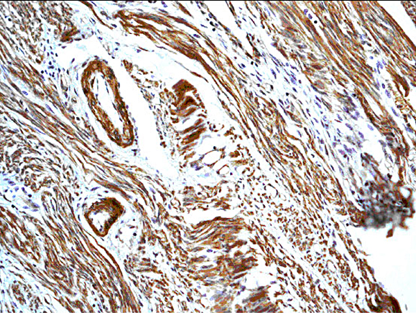 Formalin-fixed and paraffin embedded human uterus labeled with Anti-Calretinin\/CA Polyclonal Antibody, Unconjugated (bs-0062R)  followed by conjugation to the secondary antibody and DAB staining