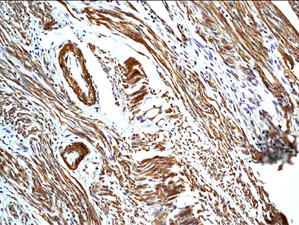 Formalin-fixed and paraffin embedded human uterus labeled with Anti-Calretinin/CA Polyclonal Antibody, Unconjugated (bs-0062R) followed by conjugation to the secondary antibody and DAB staining