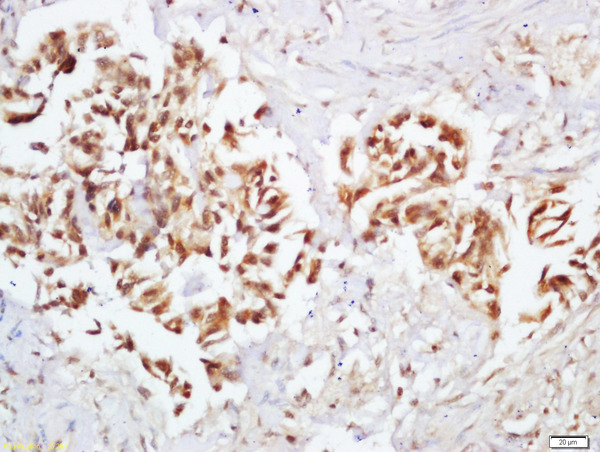 Formalin-fixed and paraffin embedded human colon carcinoma labeled with Rabbit Anti-Ep300 (Ser1834) Polyclonal Antibody, Unconjugated (bs-5339R) at 1:200 followed by conjugation to the secondary antibody and DAB staining