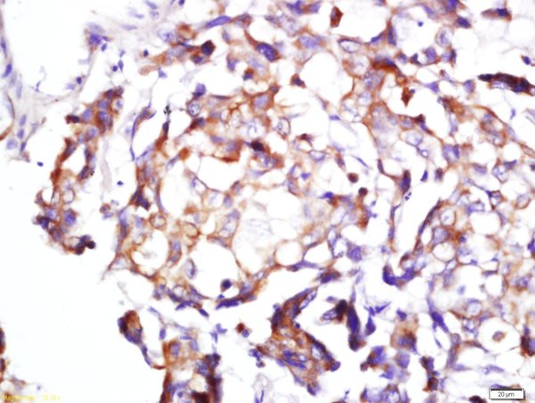 Formalin-fixed and paraffin embedded human lung cancer labeled with Rabbit Anti-BDKRB1 Polyclonal Antibody, Unconjugated (bs-8675R) at 1:200 followed by conjugation to the secondary antibody and DAB staining