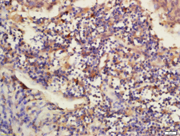 Formalin-fixed and paraffin embedded human laryngo carcinoma labeled with Rabbit Anti-DNAJB12 Polyclonal Antibody, Unconjugated (bs-14371R) at 1:200 followed by conjugation to the secondary antibody and DAB staining