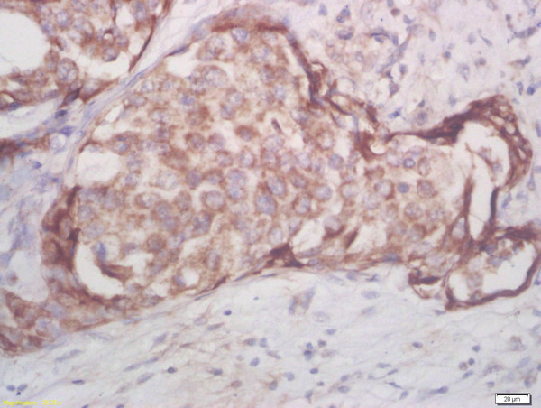 Formalin-fixed and paraffin embedded human breast cancer labeled with Rabbit Anti-AKT1/2/3 (Thr305/308/309) Polyclonal Antibody, Unconjugated (bs-5182R) at 1:200 followed by conjugation to the secondary antibody and DAB staining