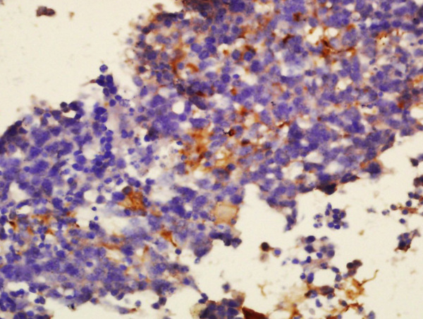 Formalin-fixed and paraffin embedded human glioma tissue labeled with Anti-Sialoadhesin Polyclonal Antibody, Unconjugated (bs-10751R) at 1:300 followed by conjugation to the secondary antibody (bs-0295G-HRP) and DAB staining.