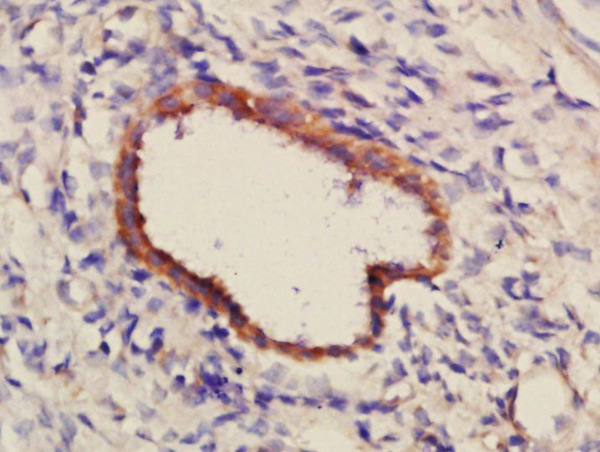 Formalin-fixed and paraffin embedded human glioma tissue labeled with Anti-PCDH7 Polyclonal Antibody, Unconjugated (bs-11085R) at 1:300 followed by conjugation to the secondary antibody (bs-0295G-HRP) and DAB staining.