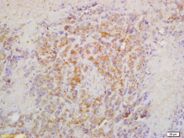 Formalin-fixed and paraffin embedded mouse lymphoma labeled with Rabbit Anti CRTAM Polyclonal Antibody, Unconjugated (bs-4957R) at 1:200 followed by conjugation to the secondary antibody and DAB staining